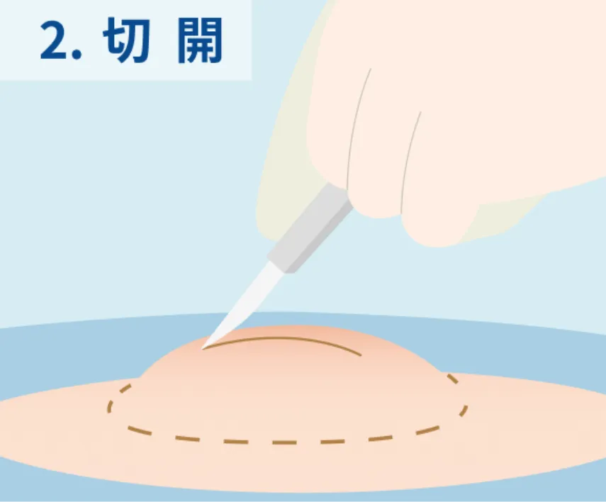 切開