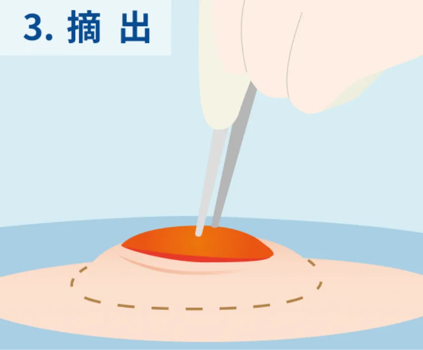 摘出