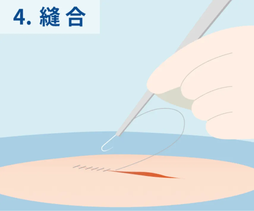 縫合