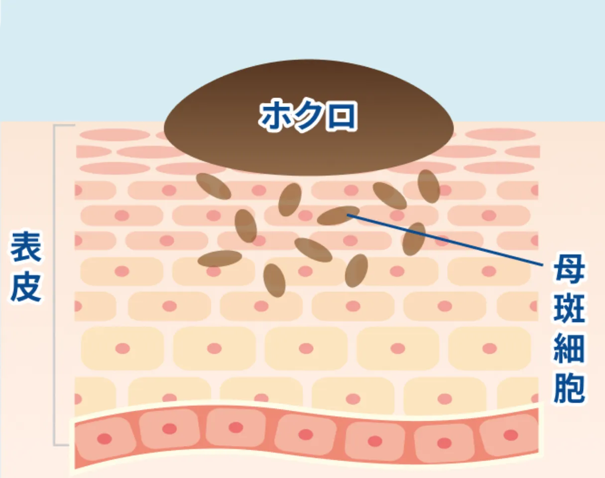 ホクロとは