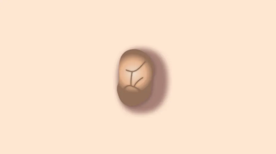 脂漏性角化症（老人性疣贅、イボ）