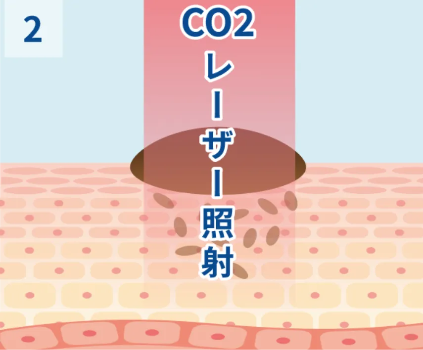 CO2レーザー 照射