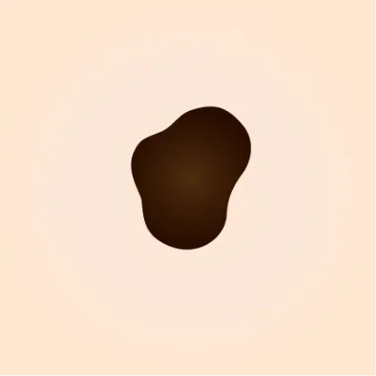 スピッツ(Spitz)母斑