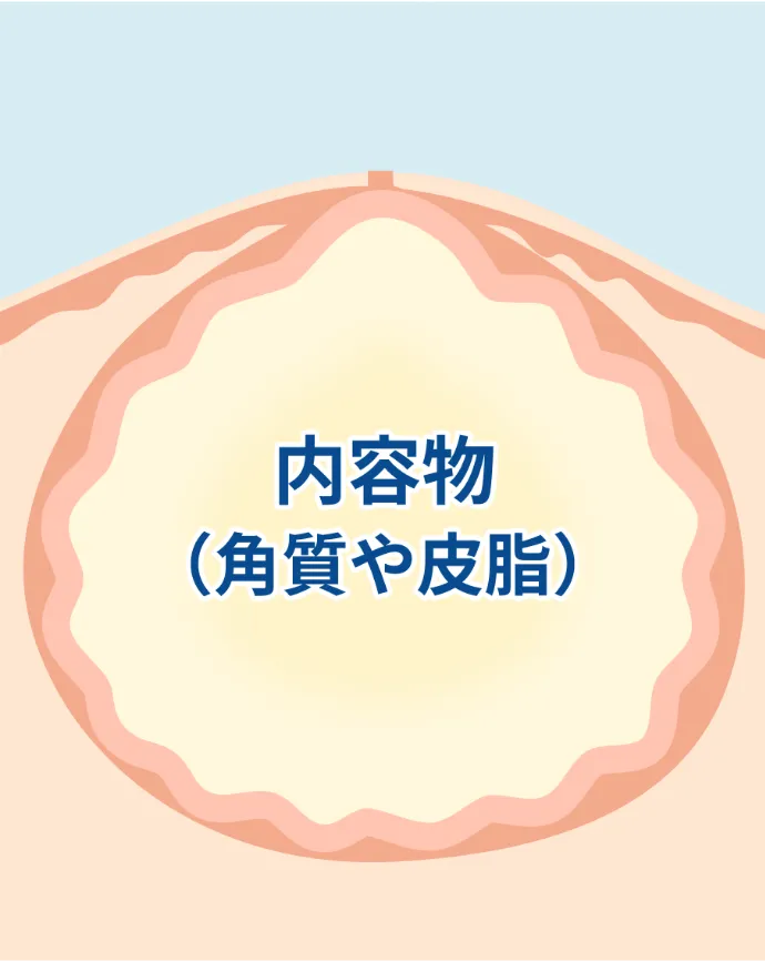 粉瘤