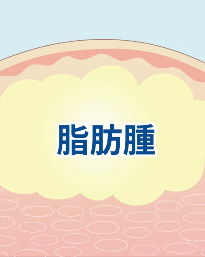 脂肪腫